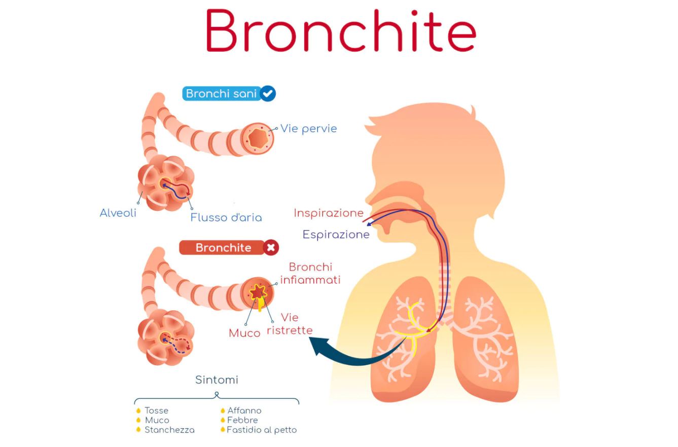 bronchite, causa cura e rimedi